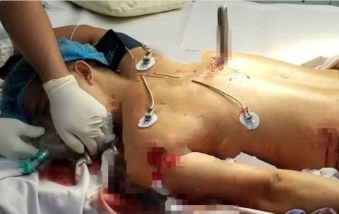 Thanh niên mang con dao cắm sâu ở lưng vào phòng mổ