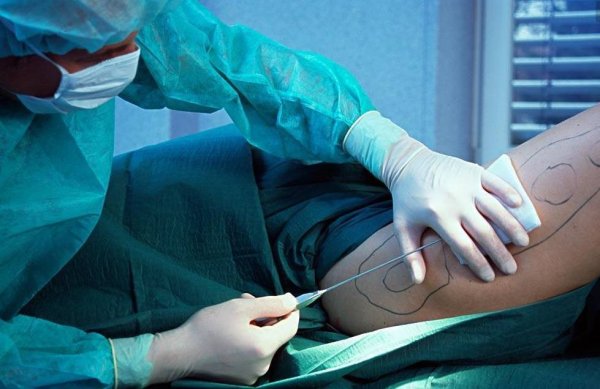 Số phận bi thảm của cô gái đầu tiên hút mỡ trong lịch sử