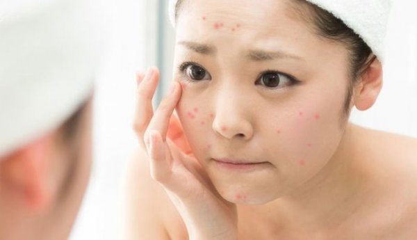 "Vạn lần" không được nặn mụn, nếu không tin thì đọc ngay bài viết này ngay!