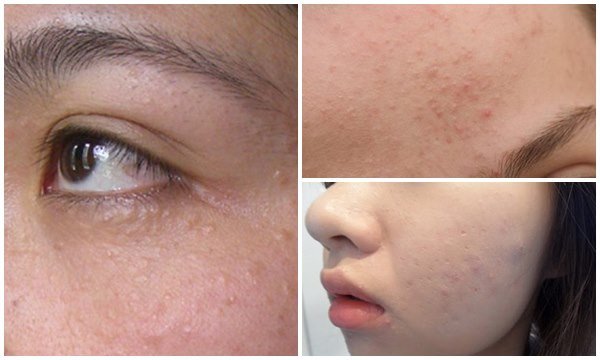 Chỉ với 5 loại mặt nạ siêu rẻ này bạn sẽ chẳng phải lo lắng về mụn ẩn trên gương mặt nữa
