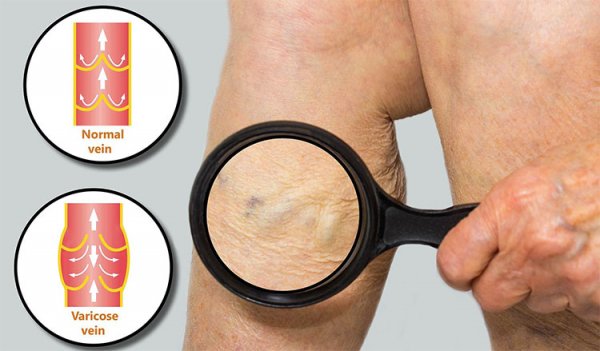 Giãn tĩnh mạch là bệnh gì? Triệu chứng, chẩn đoán và cách điều trị giãn tĩnh mạch