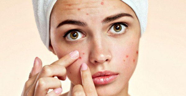 Những sai lầm nghiêm trọng khi trị mụn có tới 90% chị em đều nhầm lẫn