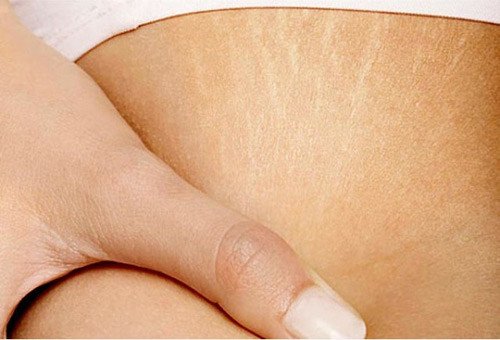 Hàng loạt sai lầm “kinh điển” về rạn da khiến việc điều trị trở lên “bế tắc”