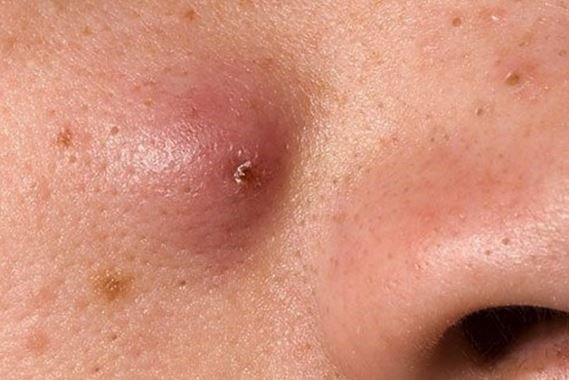 Cách Nặn Mụn Tại Nhà không để lại vết thâm mụn trong mùa dịch COVID