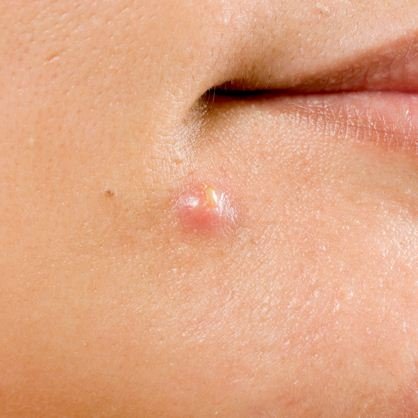 Nhan sắc “kém duyên” vì mụn trứng cá bọc? Chốt ngay nguyên nhân và cách trị tại nhà